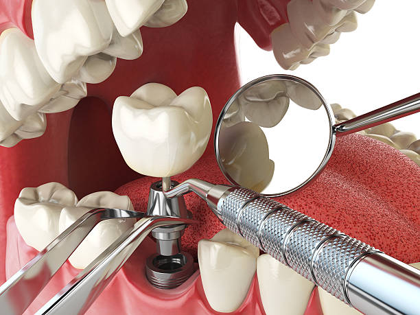 Best Lost Filling or Crown Replacement in Howey In The Hills, FL